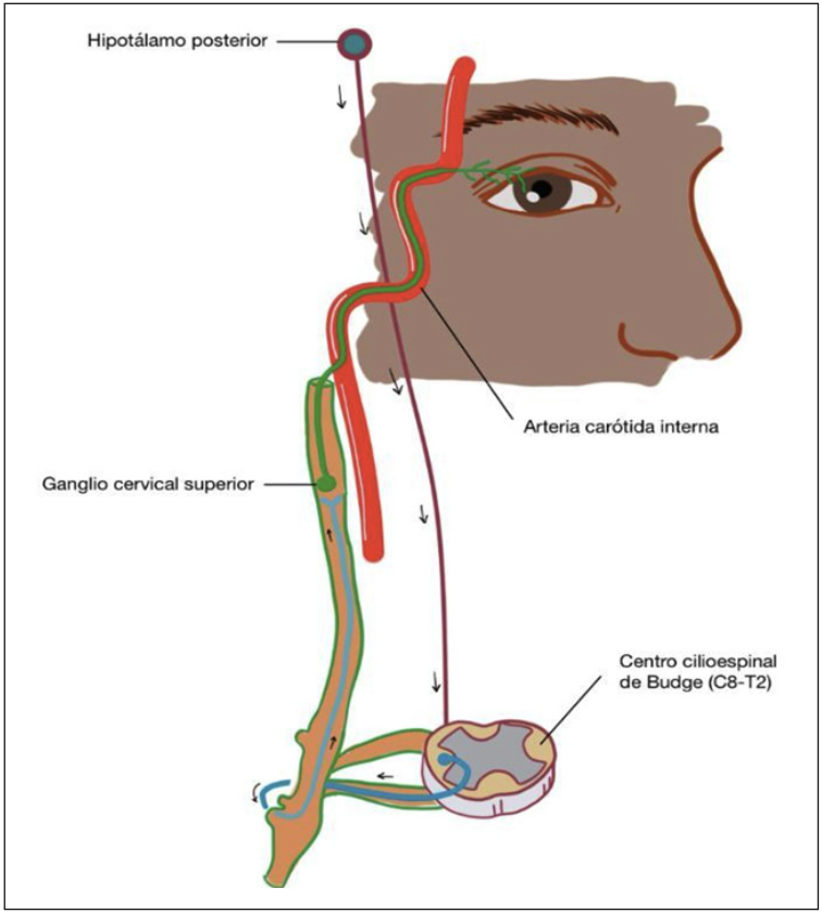 Figura 1: Esquema fisiopatología del SH. (Gráfica original de los autores)